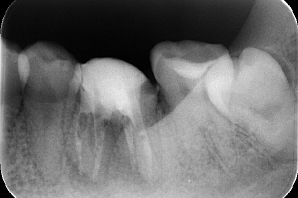 根管治療終了時