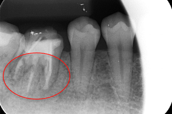 術後薬約2ヶ月後