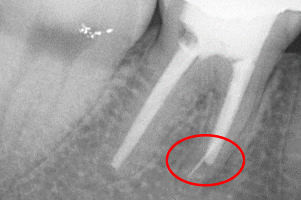 治療前のレントゲン