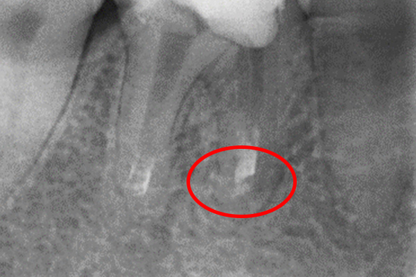治療後のレントゲン