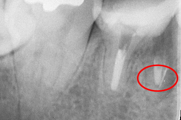 治療中のレントゲン