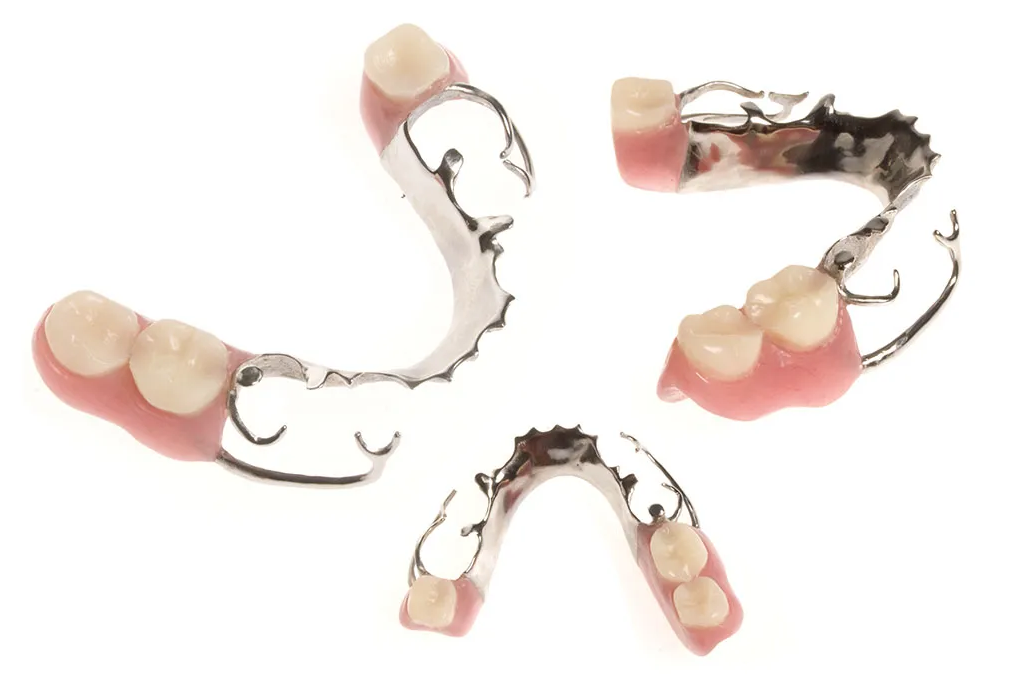 千葉県流山市・ほんだ歯科医院おおたかの森・部分入れ歯（部分床義歯）