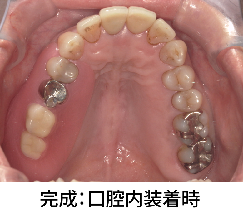 完成：口腔内装着時
