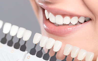 ホワイトニング